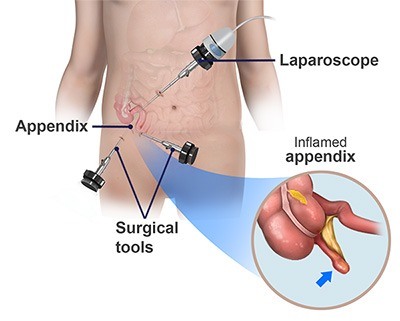 Appendicectomy