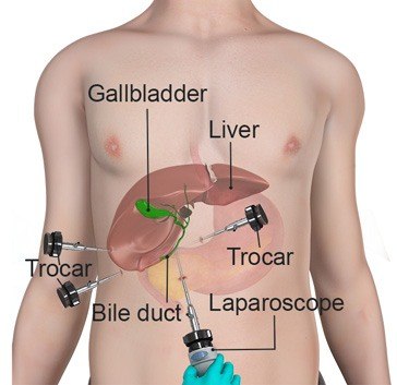 Bile Duct Surgery