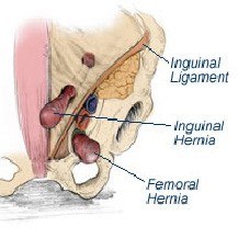 Femoral Hernia