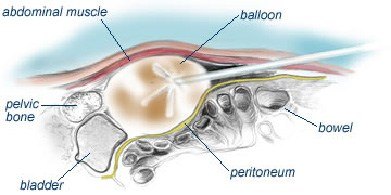 keyholesurgery