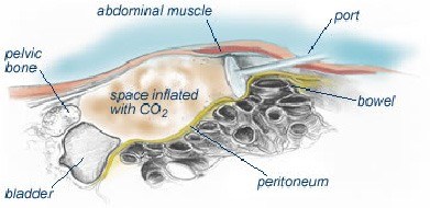 keyholesurgery