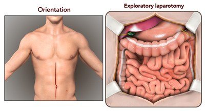 Laparotomy