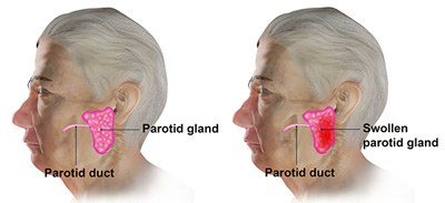 Parotitis