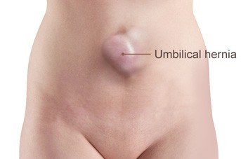 Umbilical Hernia Repair