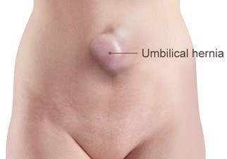 Umbilical Hernia Treatment Melbourne